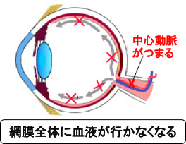 網膜中心動脈閉塞症