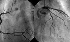 冠動脈造影検査(カテーテル検査)