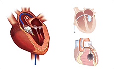 構造的心疾患(Structural Heart Disease)
