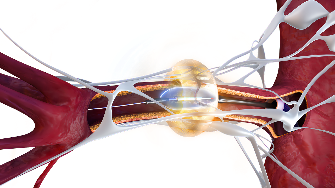 腎デナベーション(Paradise)2.png