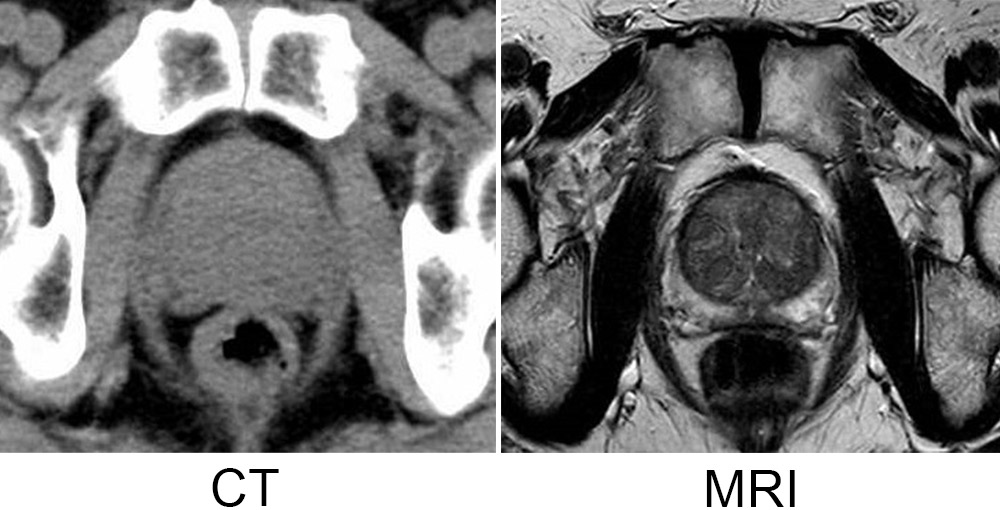 写真：前立腺の画像をCTとMRIで比較