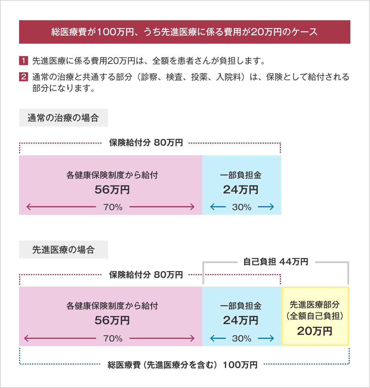 図:総医療費が100万円、うち先進医療費用が20万円の例。先進医療費用は全額自己負担、通常の治療と共通する80万円が保険診療になる。