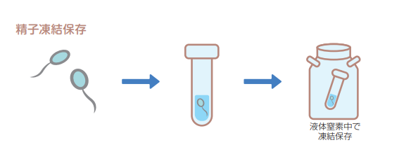 精子凍結保存